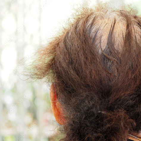 The Future of Hair Restoration: Harnessing the Power of Exosomes