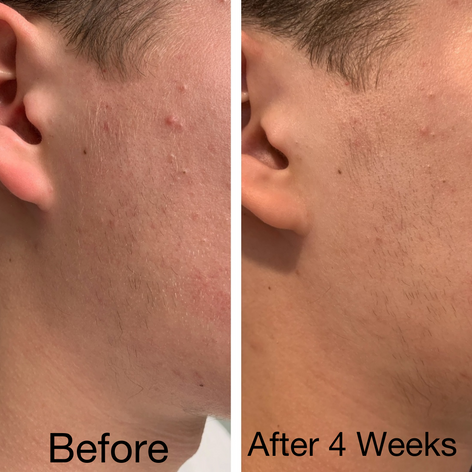 Face Acne Head-On: The AcFree Solution